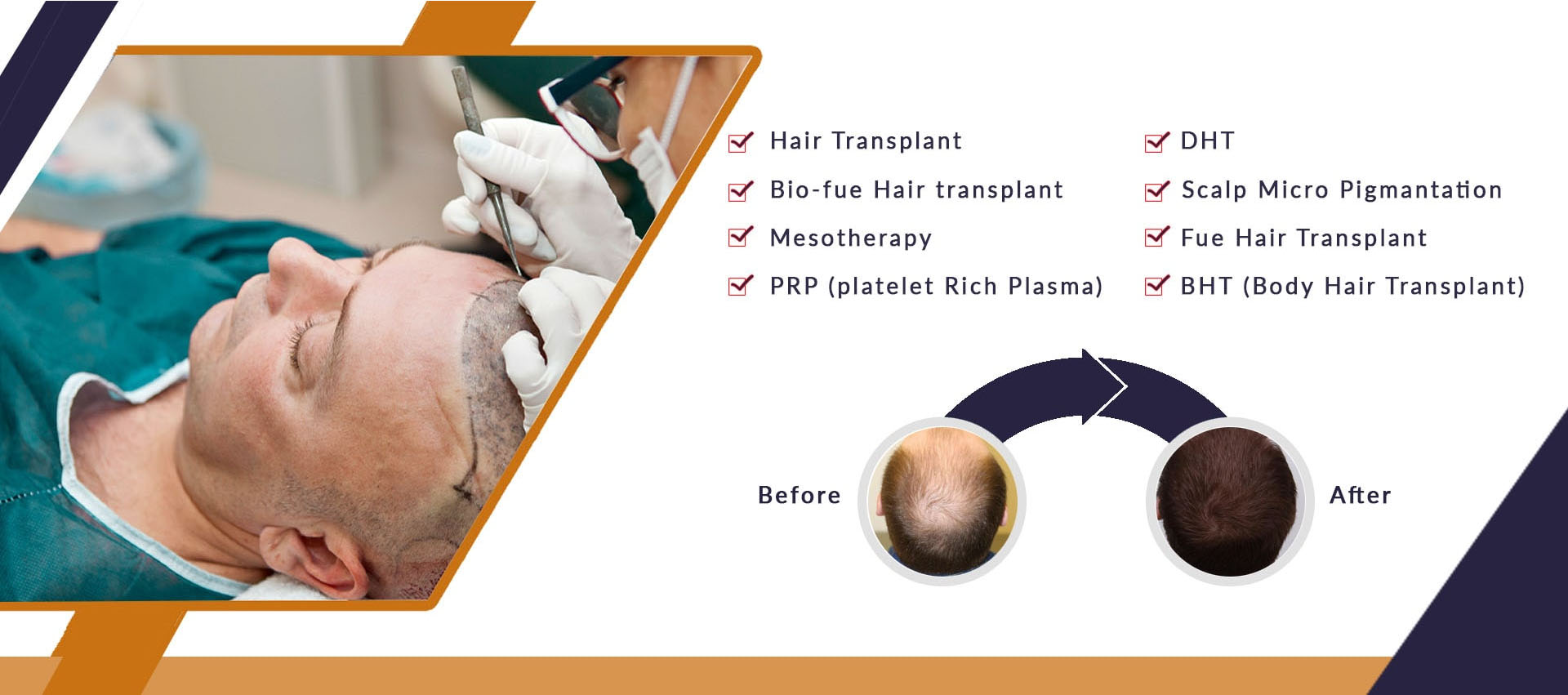 expretzhair transplantation treatment